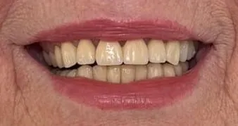 Teeth before and after implant treatment
