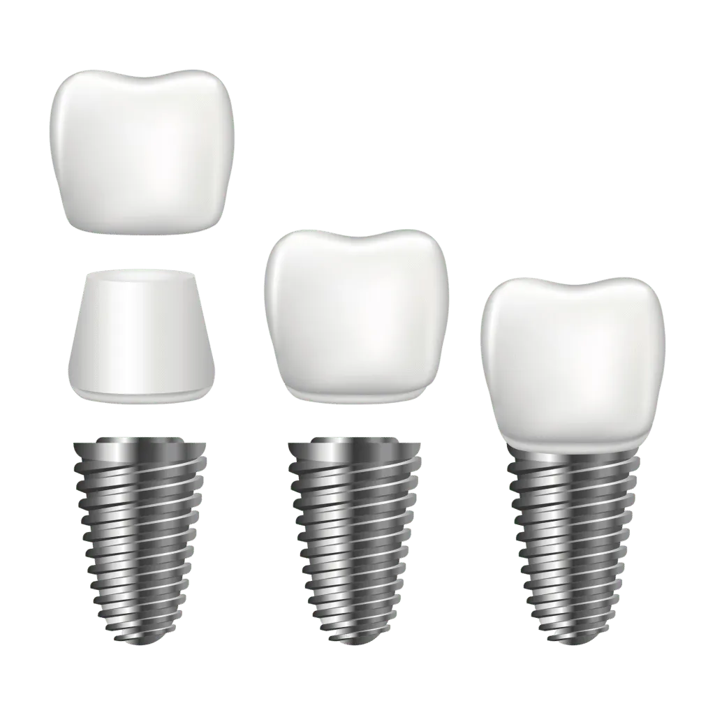 Structure of a dental implant: implant, abutment and crown